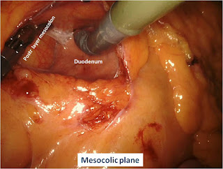 Minimally Invasive Colorectal Surgery Minimally Invasive Colorectal Surgery