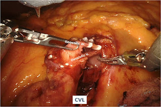 Minimally Invasive Colorectal Surgery Minimally Invasive Colorectal Surgery