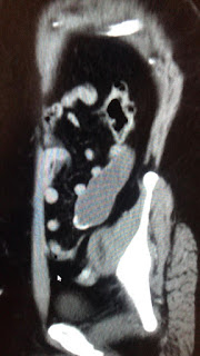 Tumors of Appendix