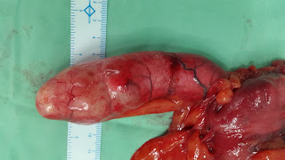 Tumors of Appendix