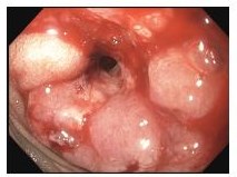 Cancer of distal duodenum: Whipple's procedure