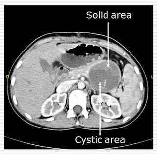 Cystic tumor of Pancreas Cystic tumor of Pancreas