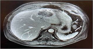 Surgery for intrahepatic cholangiocarcinoma (IHC) Surgery for intrahepatic cholangiocarcinoma (IHC)