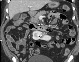 Cancer of distal duodenum: Whipple's procedure